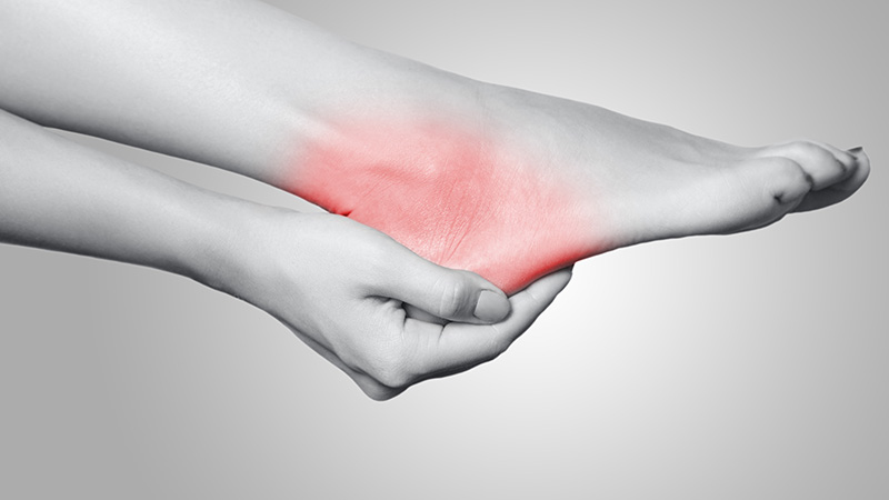 Plantar fasciitis - Kent Msk Clinic